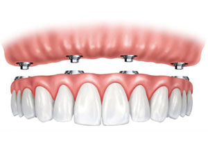 implant supported dentures top teeth