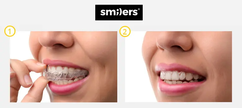 Smilers Clear Aligners Demo